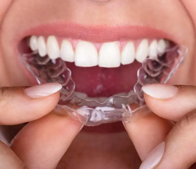 Detailaufnahme Invisalign: Zahnschiene an den Oberkiefer gehalten, aber noch nicht eingesetzt