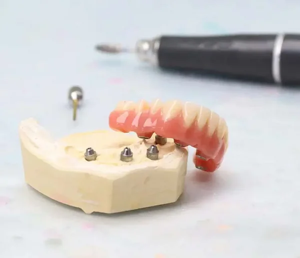 Zahnmodell mit eingesetzten Implantaten, auf denen eine herausnehmbare Prothese befestigt wird. Im Hintergrund liegt ein zahnärztliches Instrument