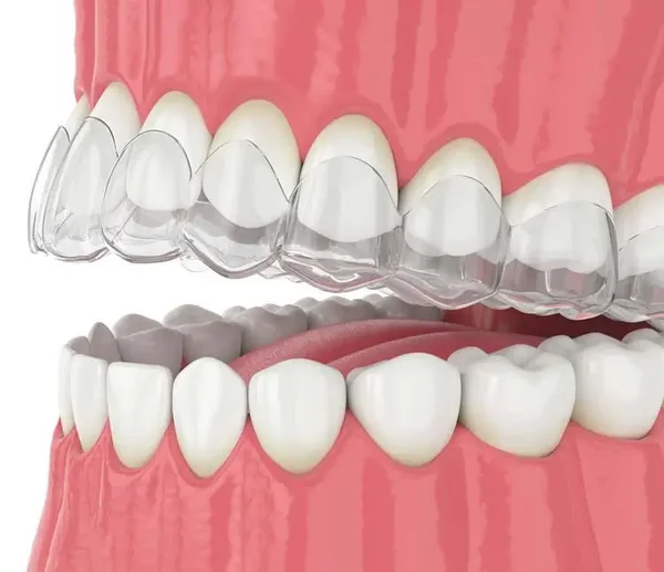 3D-Darstellung einer transparenten Invisalign-Schiene, die passgenau über die Zähne gesetzt wird