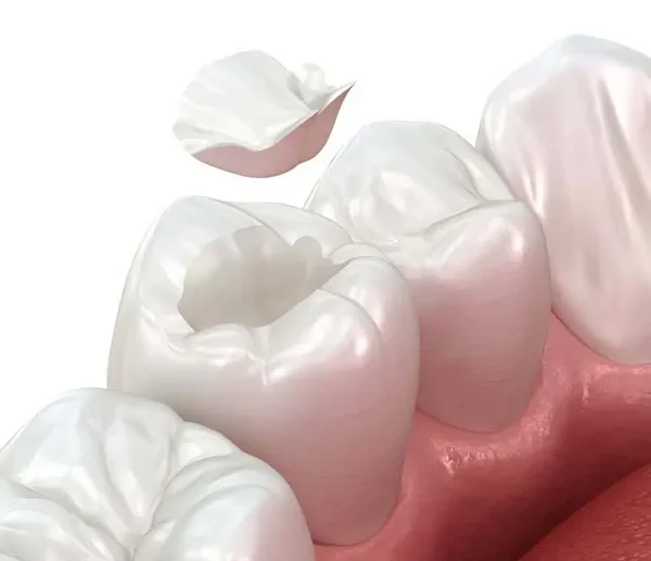 3D-Darstellung einer Zahnf&uuml;llung: Ein Inlay wird in einen vorbereiteten Backenzahn eingesetzt